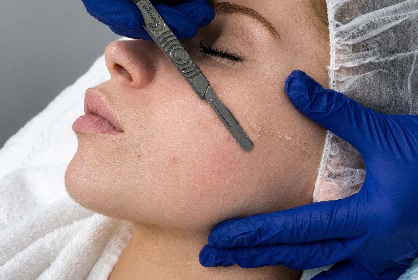 Dermaplaning